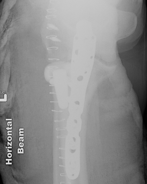 Elbow Dislocation ORIF Olecranon Replace Radial Heal LCL repair